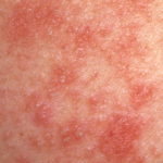 Heat rash (prickly heat): common symptoms and causes