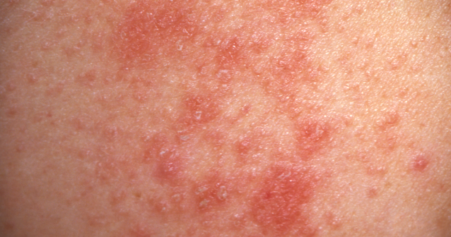 Heat rash (prickly heat): common symptoms and causes