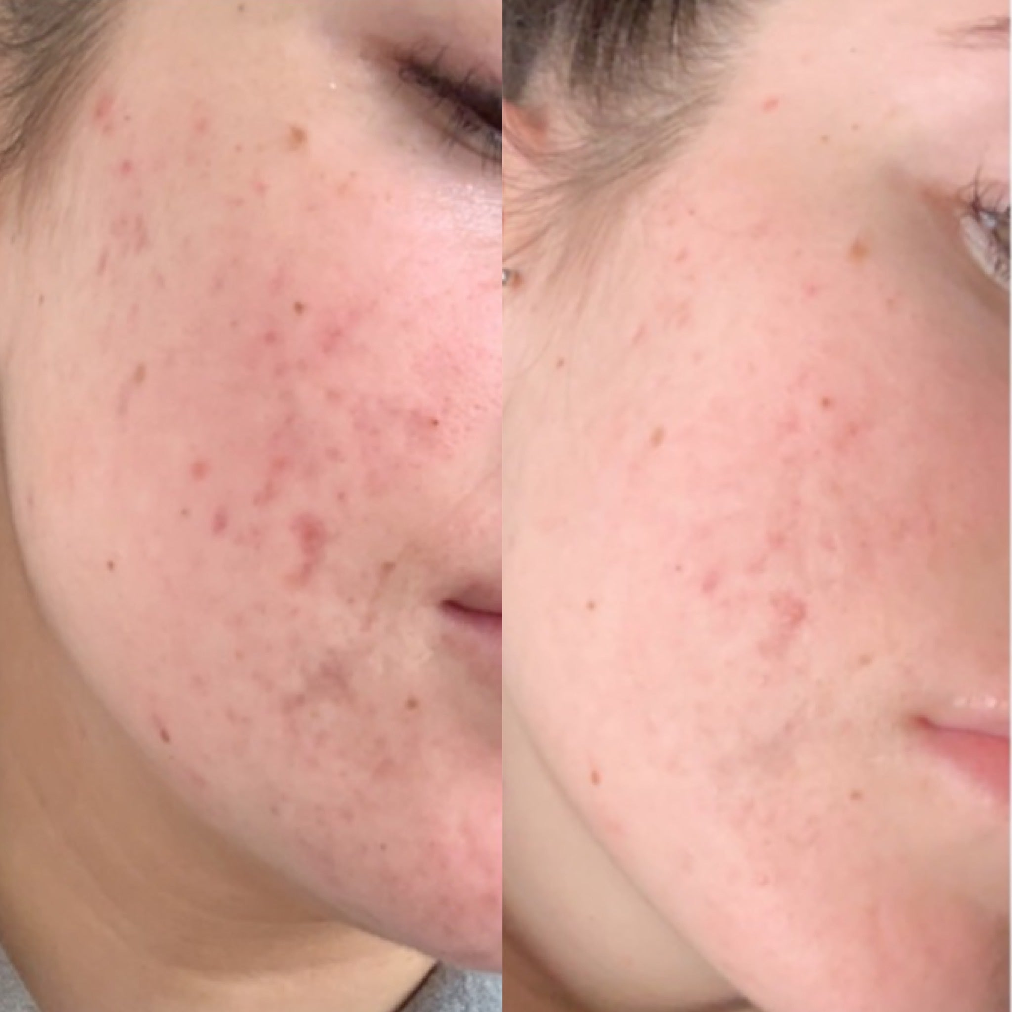 Hormonal Acne Treatment Results | Reviews | Bangn Body